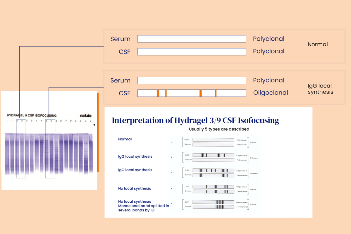 CSF oligoclonal band detection workflow using Sebia CSF Isofocusing technology