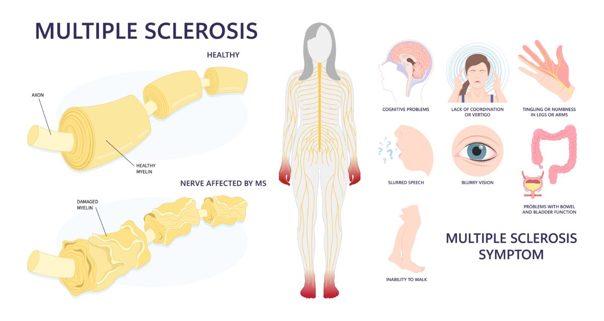 Multiple Sclerosis